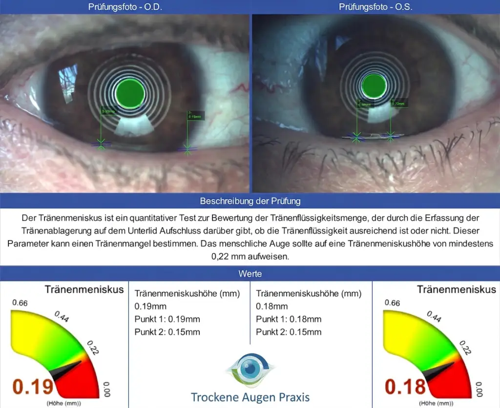 tränenmenge beim trockenen augen