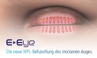 IRPL-Behandlung von trockenem Auge, E-Eye Technologie