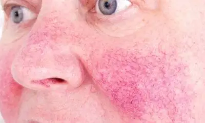 Nahaufnahme eines geröteten Gesichts mit Hautirritation.
